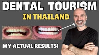 I Got 22 Crowns & 6 Veneers in Thailand 🇹🇭 SHOCKING Dental Tourism Makeover
