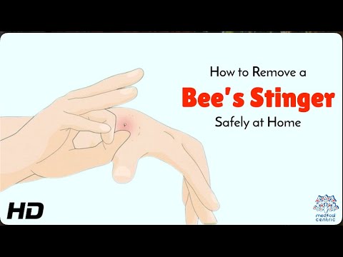 Bee Sting Emergency: What to Do First