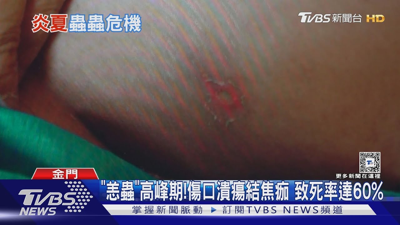 「恙蟲」高峰期!傷口潰瘍結焦痂 致死率達60%