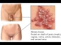 Herpes Simplex