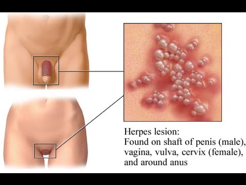 Hpv virus und herpes