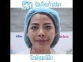 ร้อยไหม หน้าเรียว