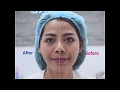 ร้อยไหม หน้าเรียว