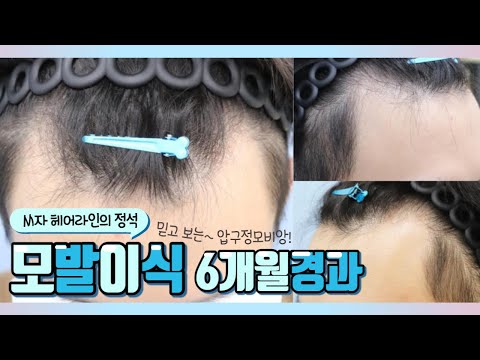 20대 후반 남성,비절개 3600모 M자 모발이식 6개월 경과영상!