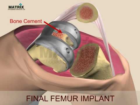 Klinik cheboksarah.po Gelenkersatz Arthrose-Arthritis des Gelenkes
