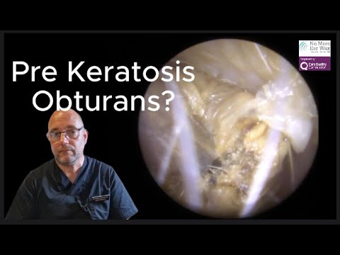 Pre Keratosis Obturans? - Episode 87 #ear #earwax #earwaxremoval