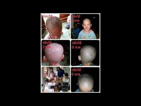 จุลินทรีย์กลากธรรมชาติบำบัด โรคสะเก็ดเงินสังกะสี