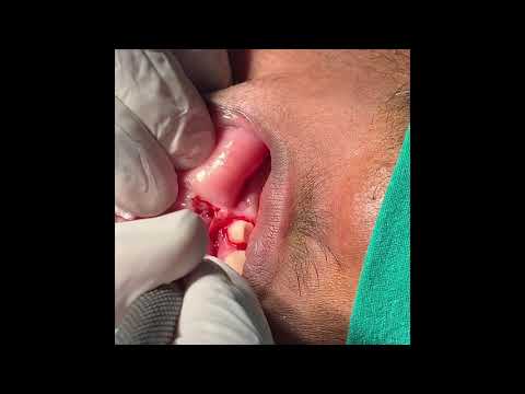 V To Y Plasty - A Simple Plastic Surgery Procedure To Release Contracture - Scar Revision