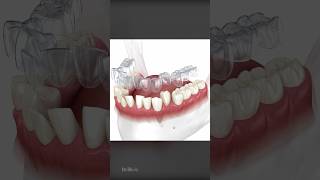 How Does Invisalign Aligners Work To Straighten Teeth