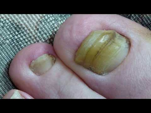 Gamot para sa fungal paa Presyo mikozan