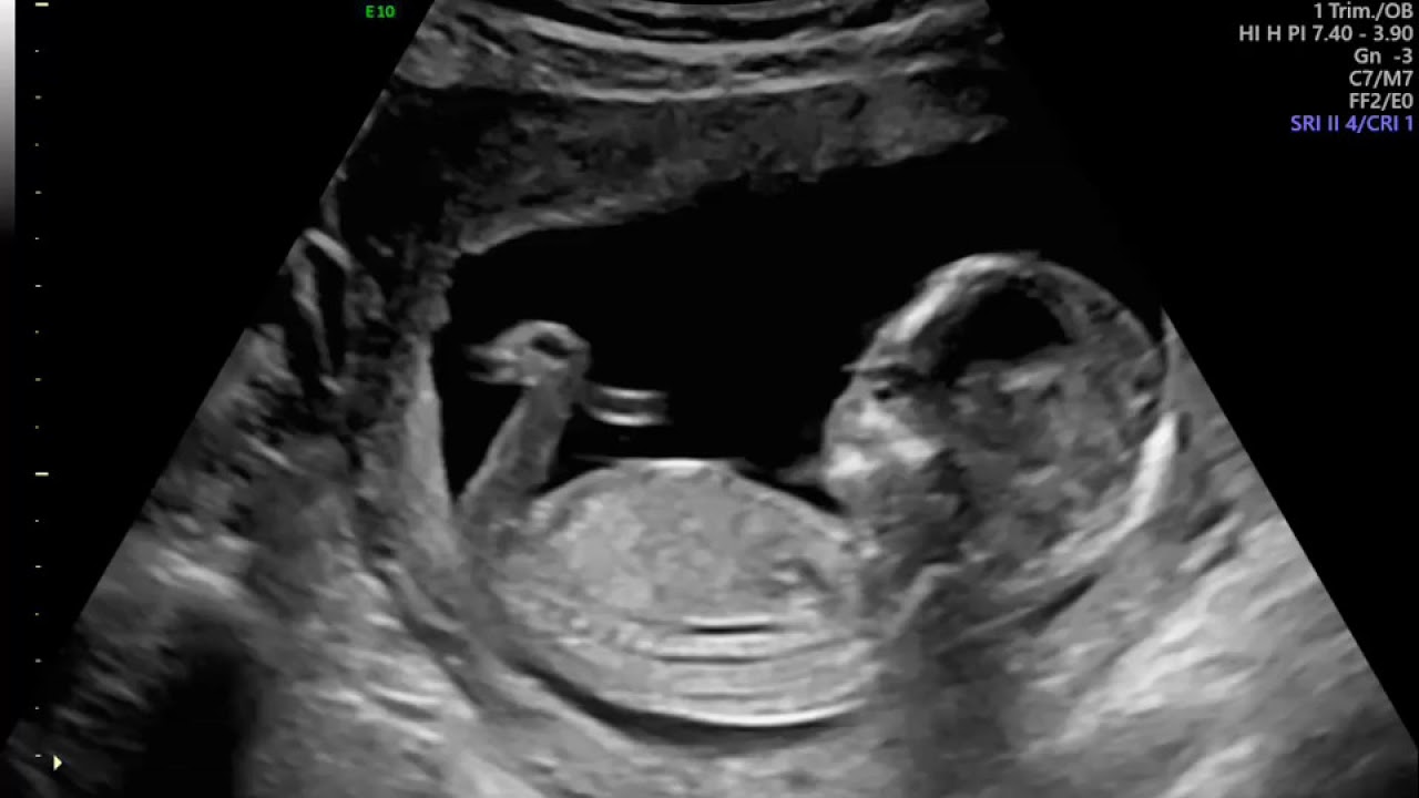 AVALIAÇÃO DE TRANSLUCÊNCIA NUCAL EM FETO DE 13 SEMANAS E 6 DIAS