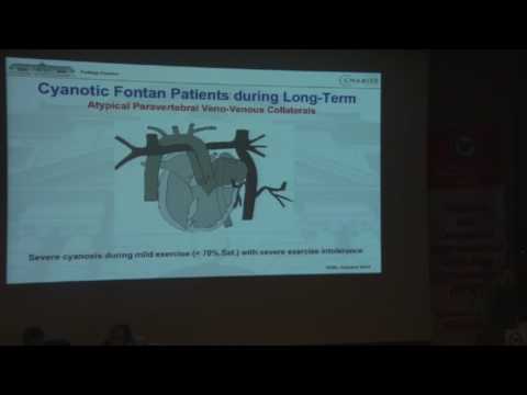 Felix Berger   Interventional options in failing Fontan