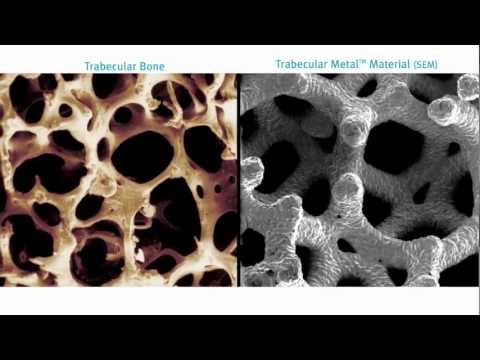 Zimmer Dental- Trabecular Metal materijal.mov