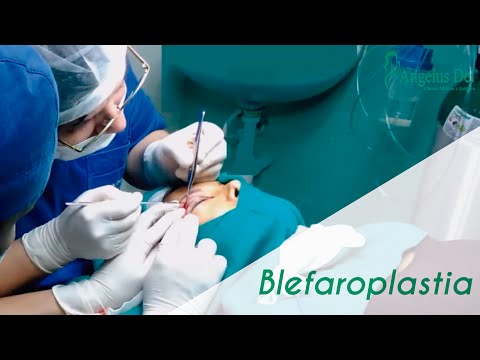 Blefaroplastia – Clínica Angelus Dei