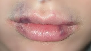 how to get rid of bruising after lip fillers tutorial