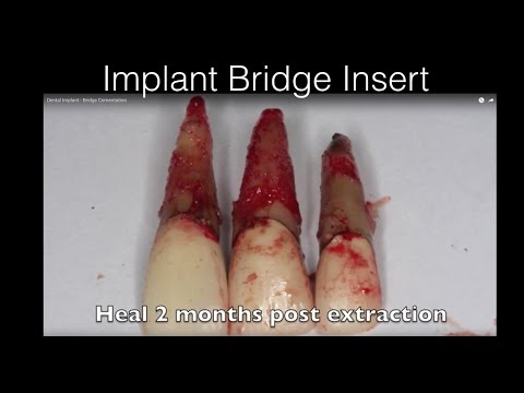Dental Implant - Bridge Cementation