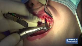 Implante 26  Tras seis meses de cicatrización se realizó Implante 24