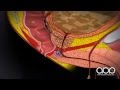 Prostate Cancer Labelled 3D Medical Animation ABP