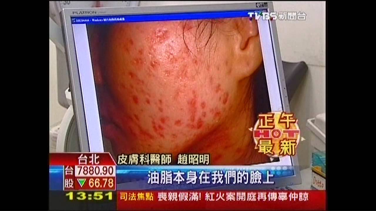 「高升糖」刺激內分泌　喝牛奶恐爆痘