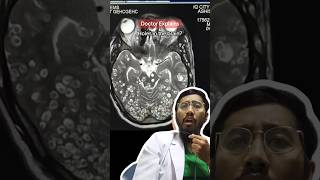 Download lagu 🦠 Otak Bolong-Bolong Akibat Parasit Ini: Mengenal Taeniasis! 🤯✨ #faktakesehatan #faktaunik mp3 Download lagu 🦠 Otak Bolong-Bolong Akibat Parasit Ini: Mengenal Taeniasis! 🤯✨ #faktakesehatan #faktaunik mp3