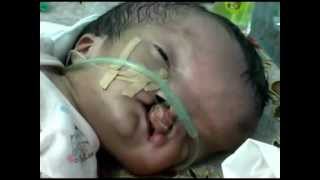 preview picture of video 'TVRI SULBAR : Bayi hidrocephalus dr Mamuju Sulbar.mpg'