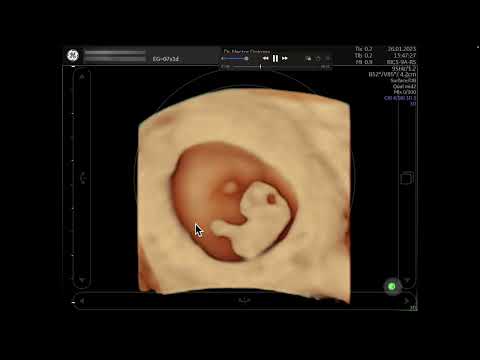 Intravaginal ultrasound: Pregnancy of 7 weeks and 6 days.