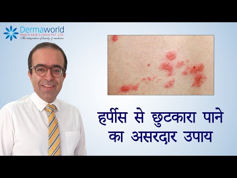 हर्पीस से छुटकारा पाने का असरदार उपाय | Dr. Rohit Batra