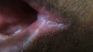 How To Cure Angular Cheilitis In 3 days?