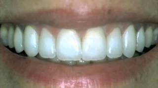 Dr Neil Baird - Healthy Teeth Tip #1 | Bairddds.com Dentist Draper 84020 Sandy Utah Healthgrades