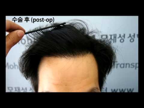 FU's FUE Hair Transplantation by Dr. Moh