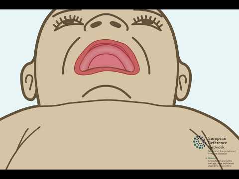 Closure of a cleft palate