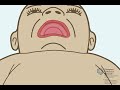 Closure Of A Cleft Palate
