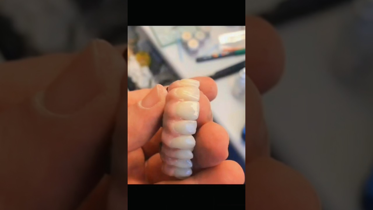 PEEK full-arch implant framework #DentalImplants #FullArch #Prosthodontics #SmileRestoration