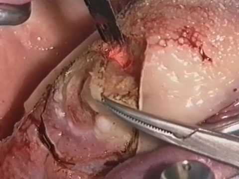 Laser resection of carcinoma and leucoplacy of the tongue