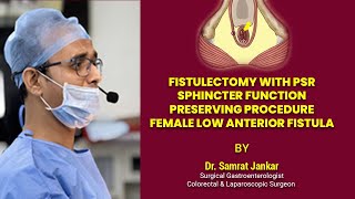 Fistulectomy with Primary Sphincter Repair | Female Low Anterior Fistula Surgery | Dr Samrat Jankar