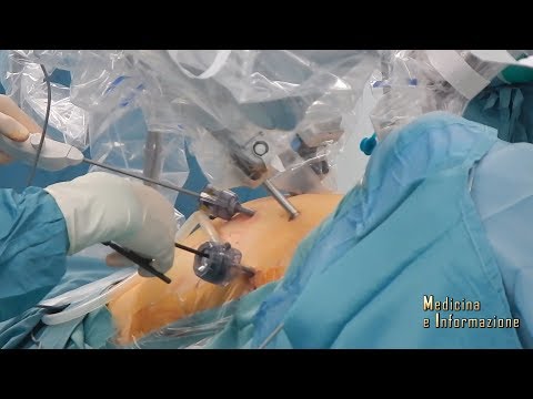 codice icd-10-pz per resezione transuretrale laser della prostata