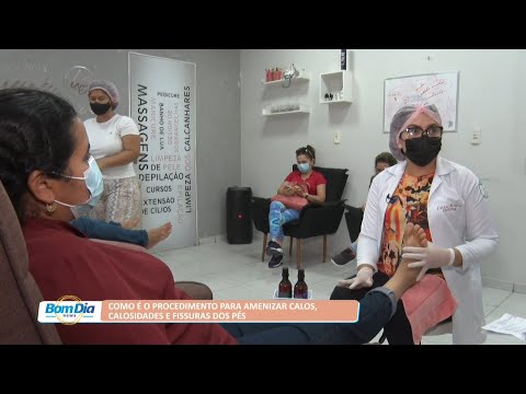 Procedimento para amenizar calos, calosidades e fissuras dos pés 30 03 2022