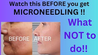 MICRONEEDLING | Watch this FIRST! The TRUTH and best RESULTS possible | Watch this TRANSFORMATION