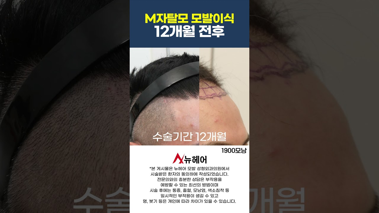 남자 엠자 탈모, 10년이 어려 보이는 모발이식 후기ㅣ1900모낭