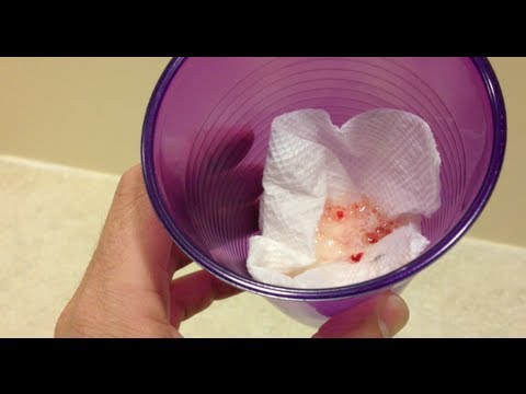 Hemoptysis - how to approach the coughing of blood patient.