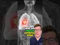 LUNG CANCER 12 Potential Signs And Symptoms Shorts Health