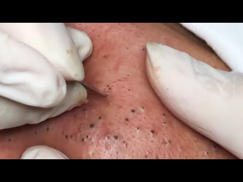 Best Blackhead Removal Ever – Facial Acne Treatment