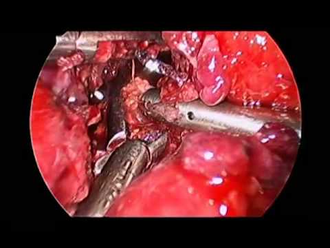 Drainage d'un abcès pancréatique avec nécrosectomie et kystogastrostomie par laparoscopie transgastrique