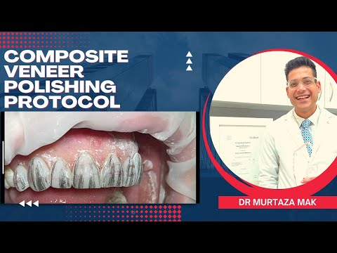 Composite Veneers Polishing Protocol