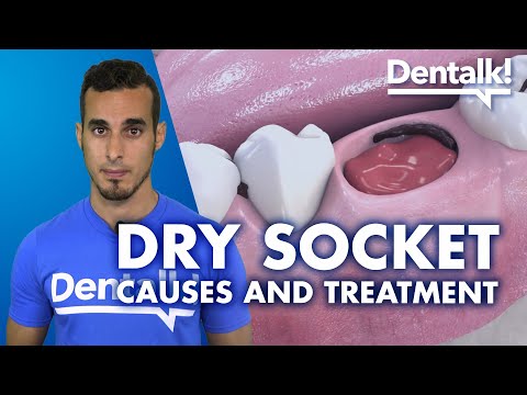 DRY SOCKET – Symptoms, treatment and causes of INFECTED tooth extraction | Dentalk! ©