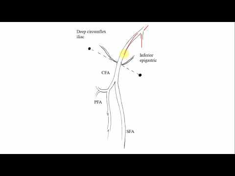 Femoral artery hemostasis in cathlab