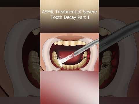 ASMR Treatment of Severe Tooth Decay Part 1  #satisfying #mushroomasmr68 #trendingshorts