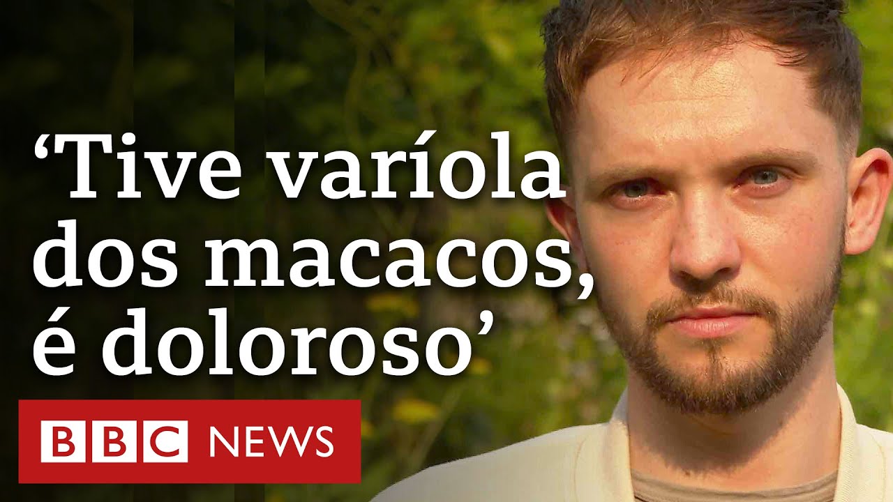 Jovem conta como é ter varíola dos macacos