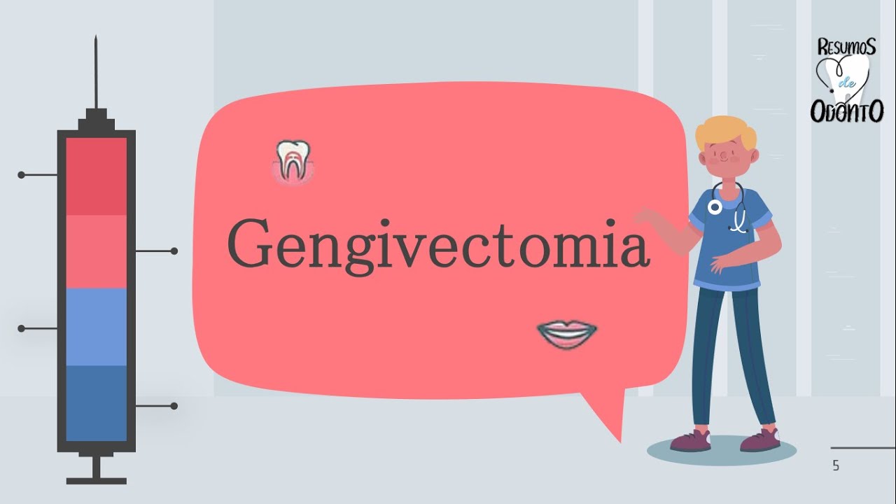 Cirurgias gengivais - Gengivectomia | Resumos de Odonto