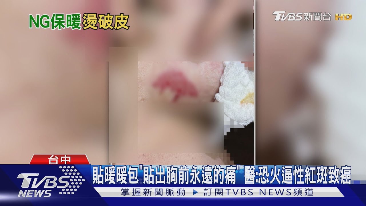 貼暖暖包「貼出胸前永遠的痛」 醫:恐火逼性紅斑致癌